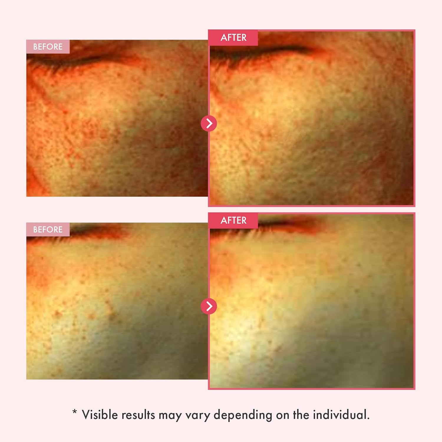 TOSOWOONG Niacinamide 10% Arbutin 7% Serum, Hyperpigmentation, Dark Spot Remover, Discoloration Correcting for Uneven Skin Tone, Glass Skin, All Skin Types, Korean Skincare, 33ml / 1.11 fl. oz. - Image 3